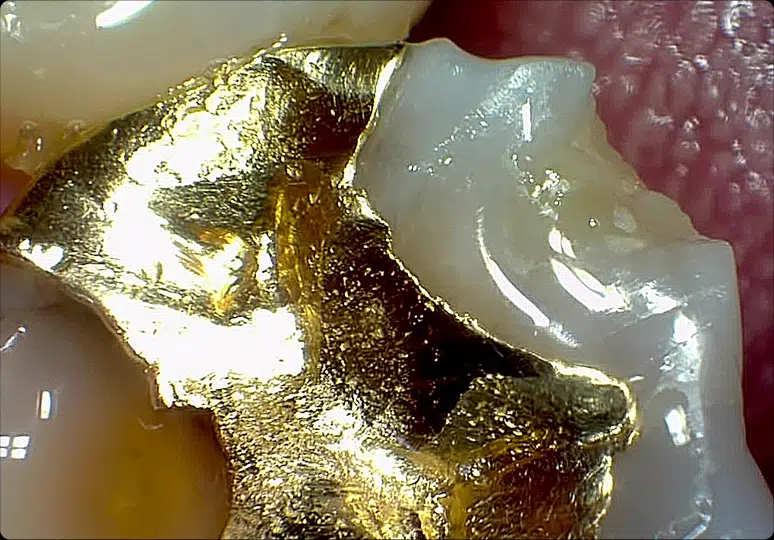 Close-up of a filling captured with a Claris i5HD camera