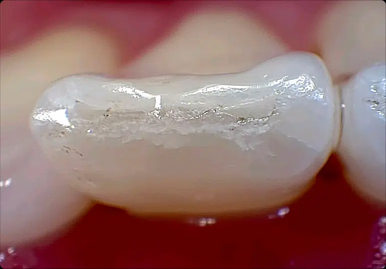 Incisor detail